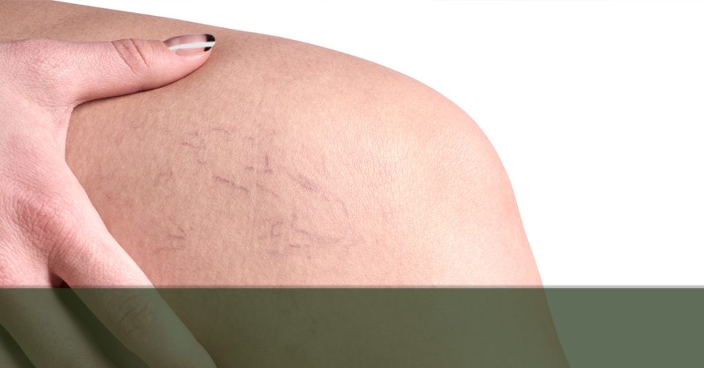 Pregnancy Vericose Veins