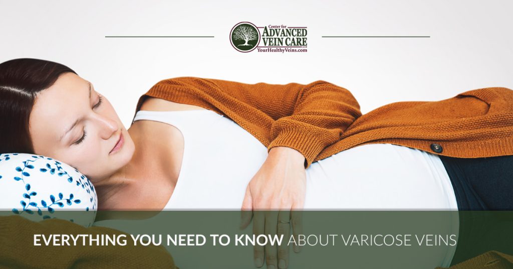 centerforhealthyveins blog FeatImage varicoseveins