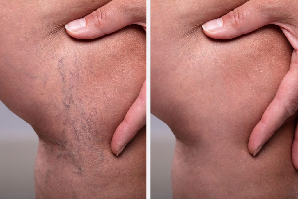 Natural Vein treatment in Ohio