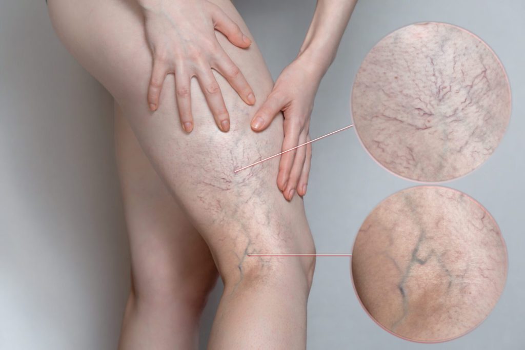 Superficial Thrombophlebitis treatment in vein clinic ohio
