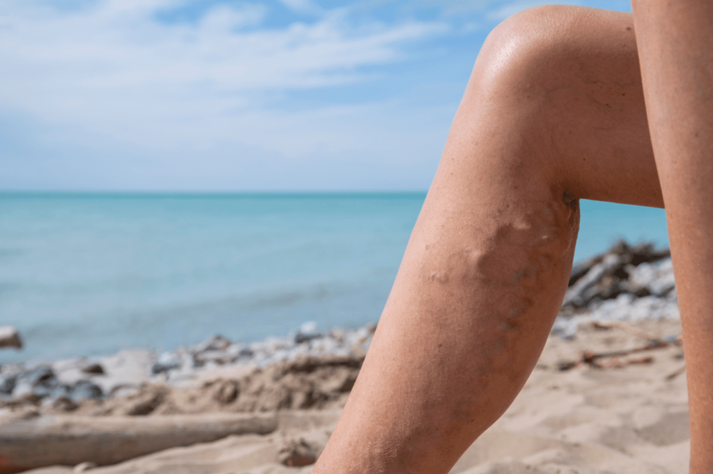 Center for advance vein care offers varicose vein treatments in mentor, Ohio